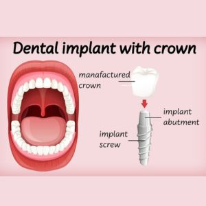 Dental Implants in Gurgaon