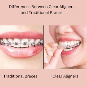 What Are Clear Aligners