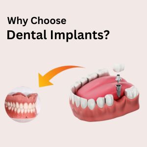 Dental Implants in Gurgaon