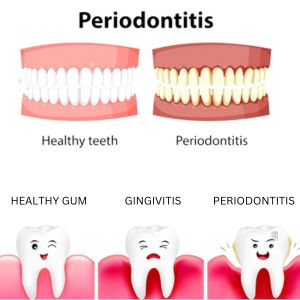 Periodontics in Gurgaon