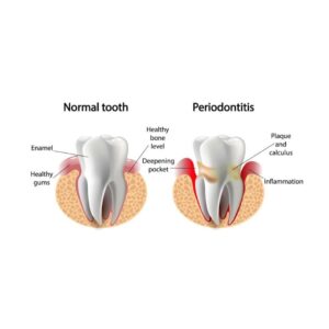 Periodontics in Gurgaon