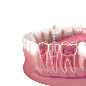 ENDODONTICS