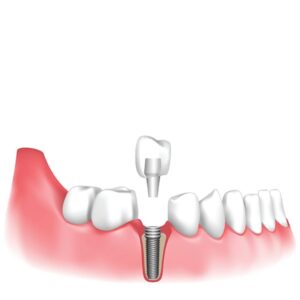 DENTAL IMPLANTS