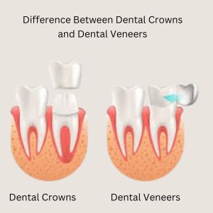 Dental Veneers in Gurgaon