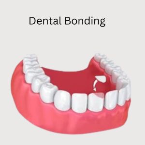 Dental Bonding Treatment in Gurgaon