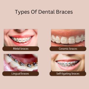 Dental Braces in Gurgaon