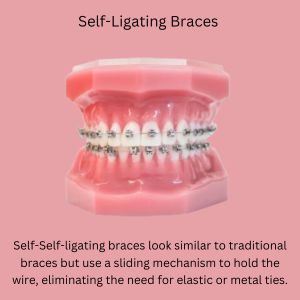 Self-Ligating Braces