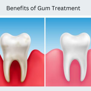 Gum Treatment in Gurgaon : Types of Gum Treatments