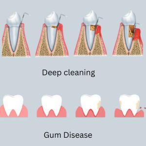 Gum Treatment in Gurgaon