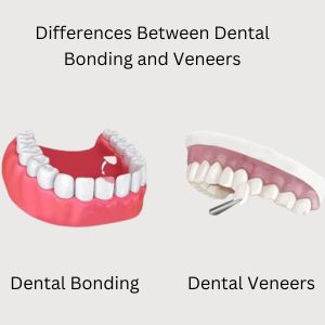 Dental Bonding and Dental Veneers