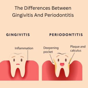 periodontitis treatment in Gurgaon