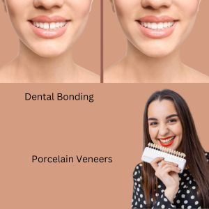 Porcelain Veneers or Dental Bonding