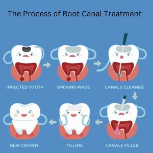 Endodontics in Gurgaon