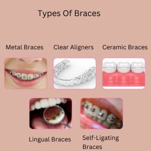 Dental Braces in Gurgaon