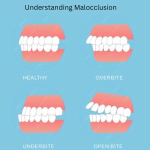 Dental Braces Help in Misaligned Teeth