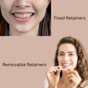 Dental Braces in Gurgaon