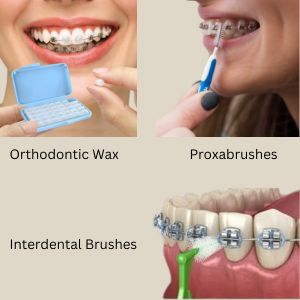 Dental Braces in Gurgaon