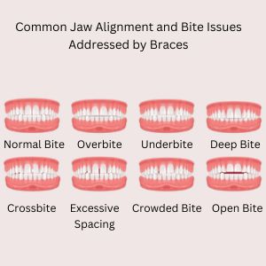 Types of Bite