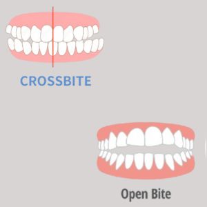 Dental Braces in Gurgaon