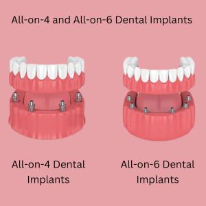 Prosthodontics in Gurgaon