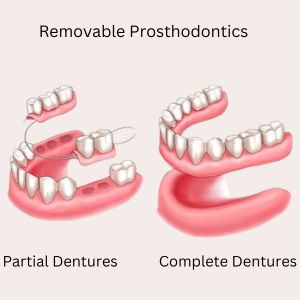 Complete Dentures vs Partial Dentures