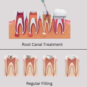 Regular Filling and a Root Canal