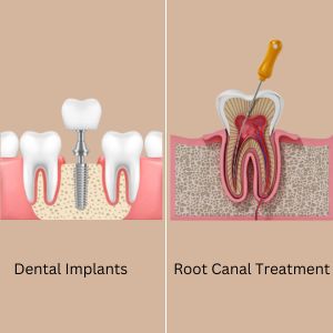 Root Canal Treatment and Dental Implants