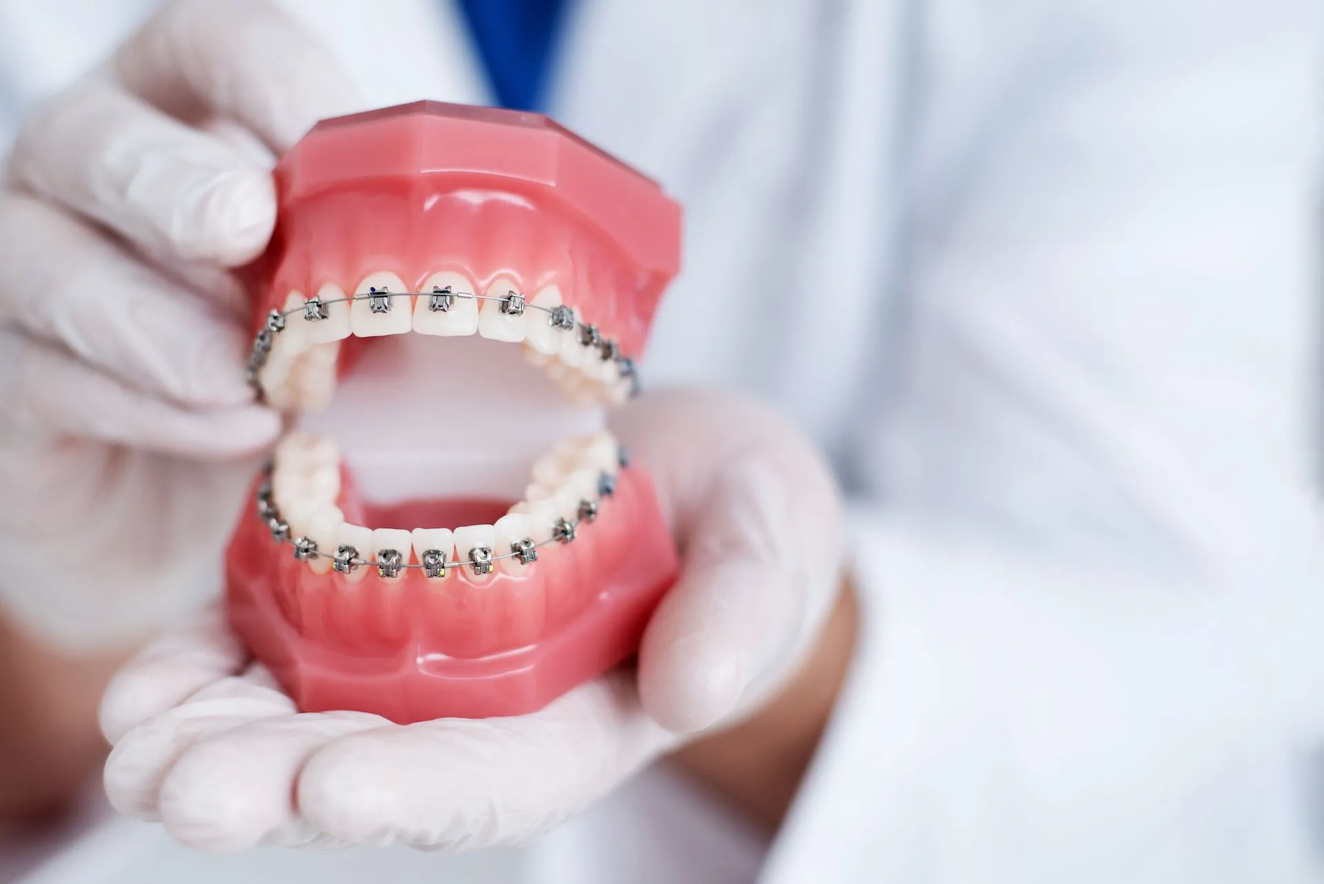 What are dental braces?