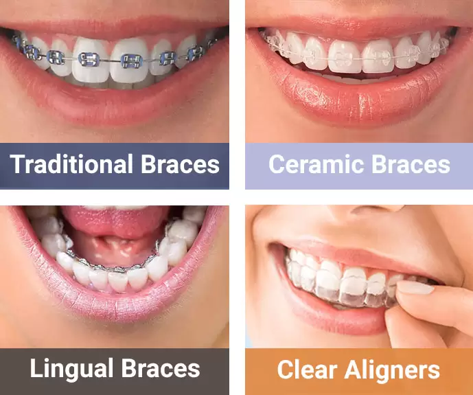 Types of dental braces