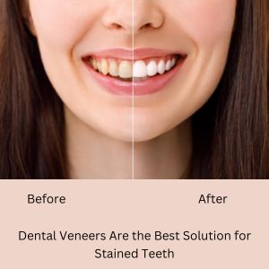 Dental Veneers Are the Best Solution