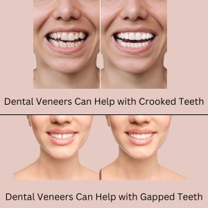 Dental Veneer in Gurgaon: Dental Veneers Help with Crooked or Gapped Teeth