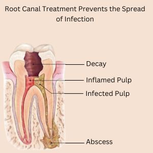 Root Canal Treatment Prevents the Spread of Infection