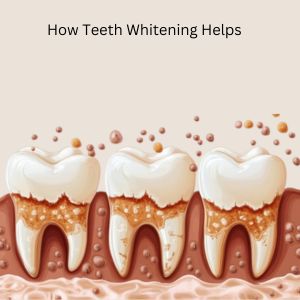 Teeth Stain: Teeth Whitening Treatment in Gurgaon