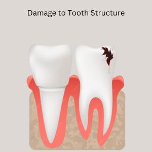 Best Dentist Gurgaon; Damage to Tooth Structure