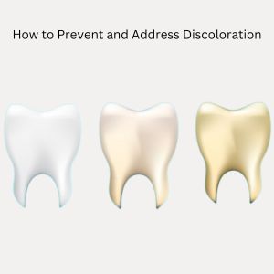 Discoloration Teeth Color Change: Teeth Whitening in Gurgaon