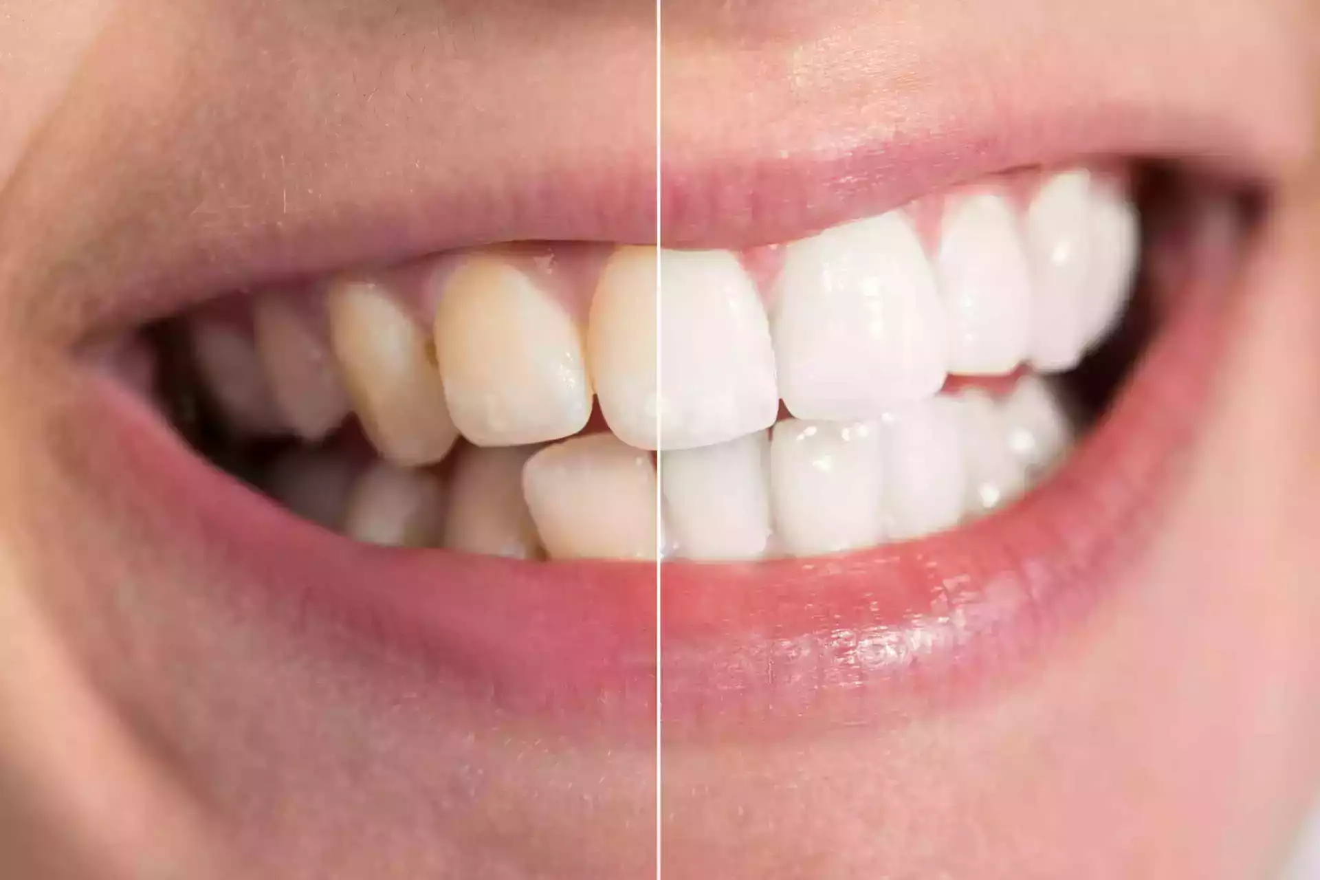 how to remove stains from teeth quickly
