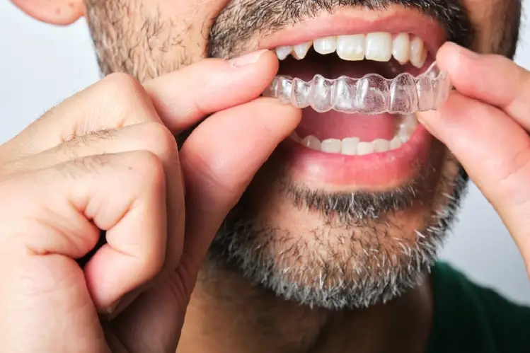 what are retainers