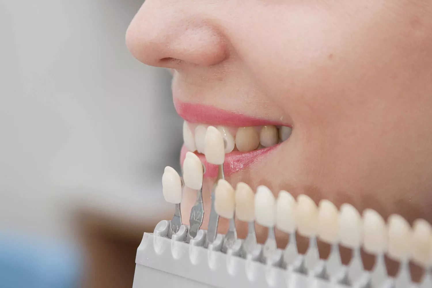 Dental veneers In Gurgaon
