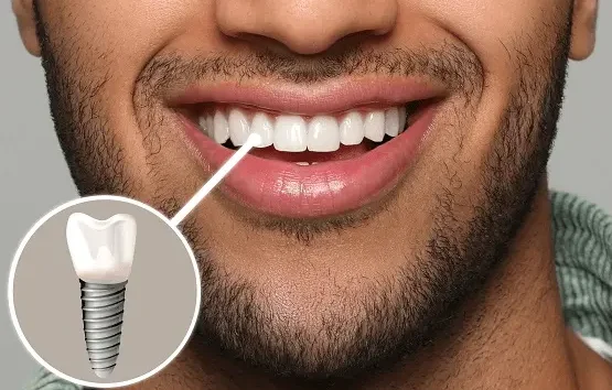 Best Dental Implant in Gurgaon
