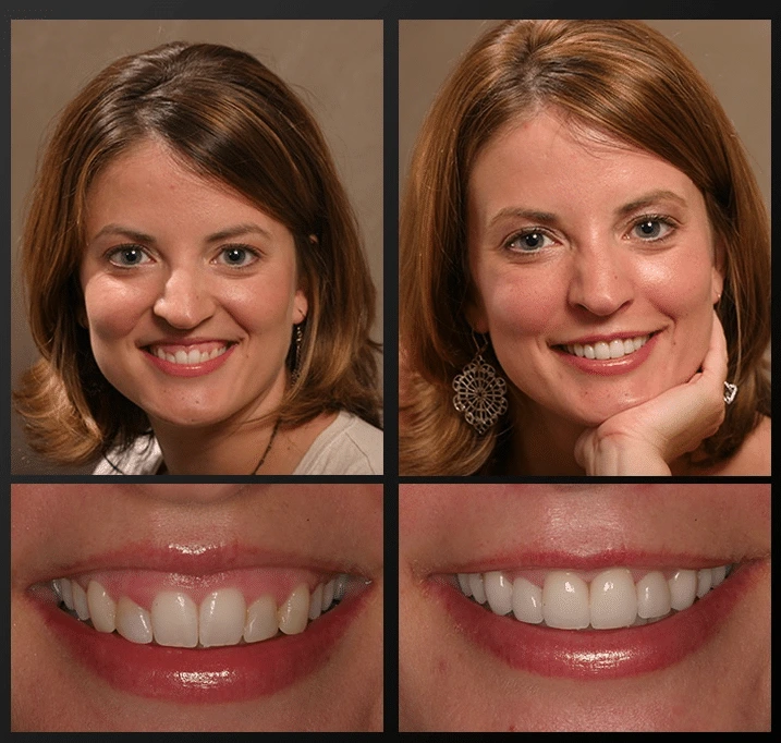 cosmetic gum treatment in Gurgaon