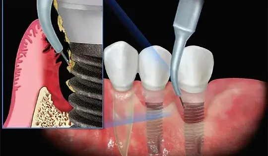 Healing period of dental implant