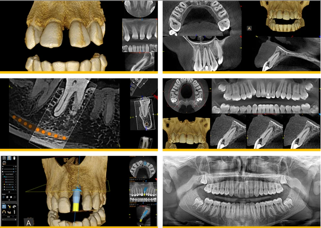 painless dental implant in Gurgaon Sector 57