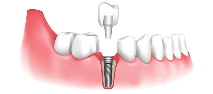 Dental implant placement