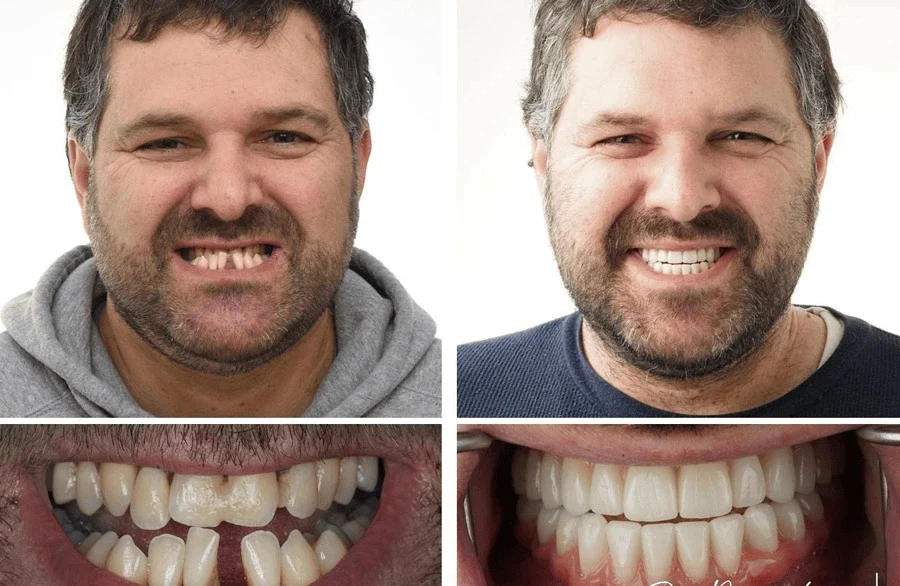 Top Dental implant surgery in Gurgaon