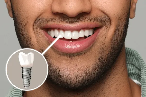 Dental Implants in Gurgaon