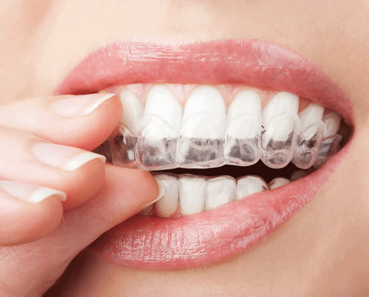 Invisalign & Clear Aligners in Gurgaon