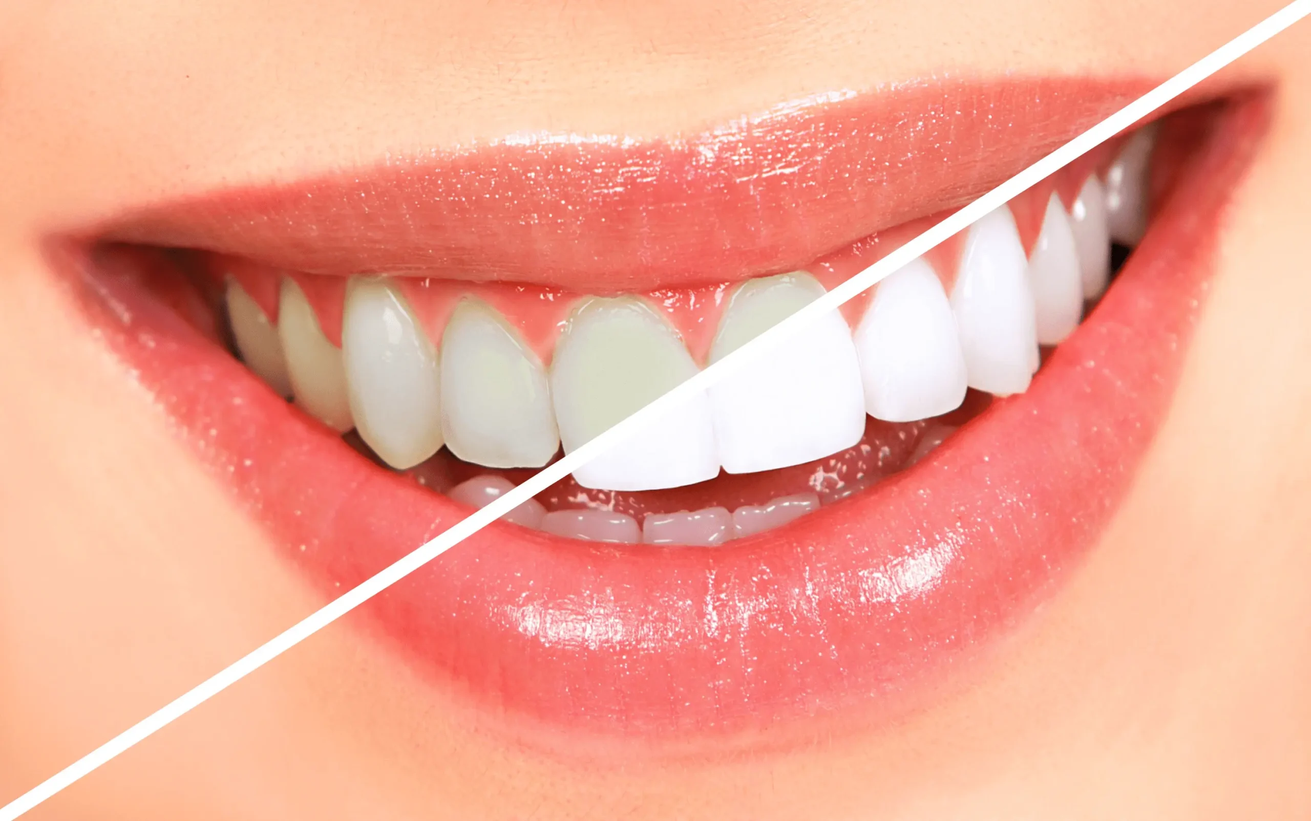 Teeth whitening In Gurgaon