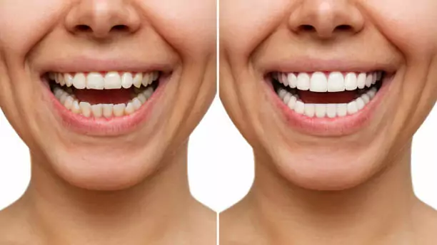 How Does Teeth Whitening Work?