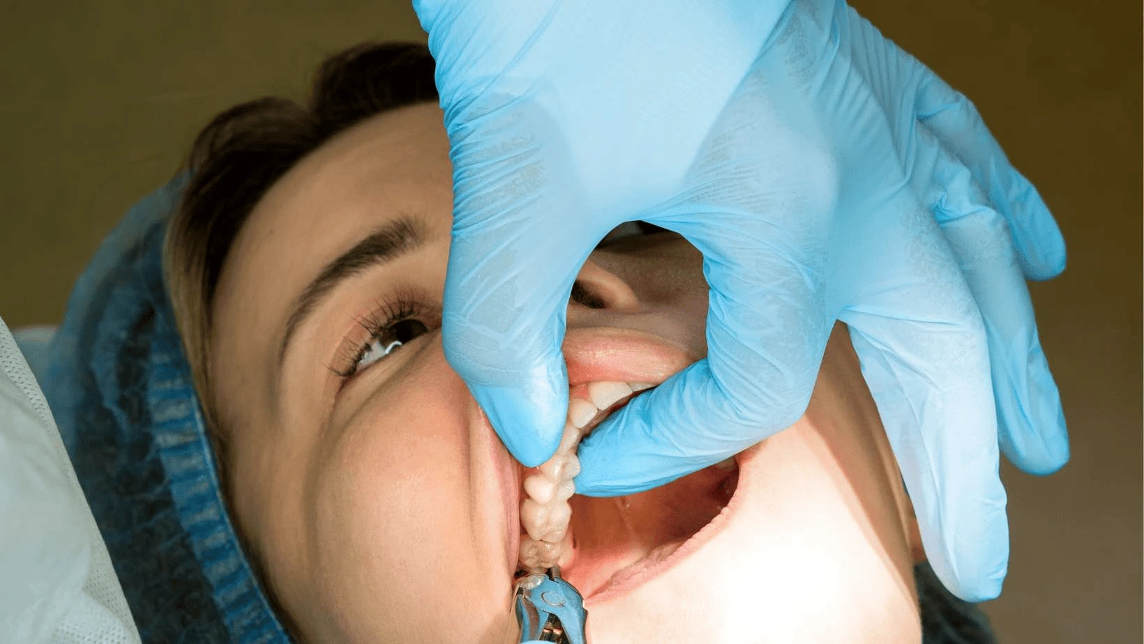 wisdom tooth surgery in Gurgaon