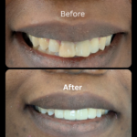 teeth whitening gurgaon